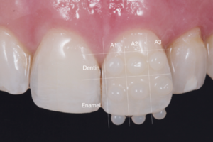 Recontorno dentário com resinas compostas após plástica periodontal