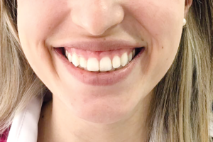 Técnica simplificada para tratamento de sorriso gengival com onatoxinabotulínica A