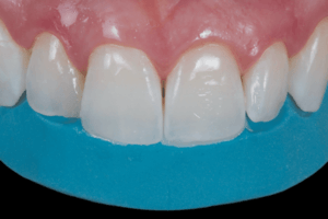 Associação de laminados cerâmicos e resinas compostas em uma reabilitação oral estética