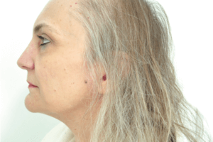 Toxina botulínica no tratamento para atenuar sinais da mímica em caso de paralisia facial