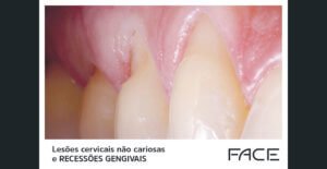 Marcelo Faveri traz uma visão  periodontal da questão das lesões cervicais não cariosas