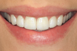Versatilidade do uso estético-funcional da toxina botulínica tipo A na Odontologia