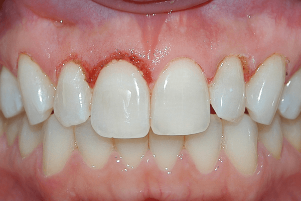 Gengivoplastia com laser cirúrgico associado à toxina botulínica na correção do sorriso gengival